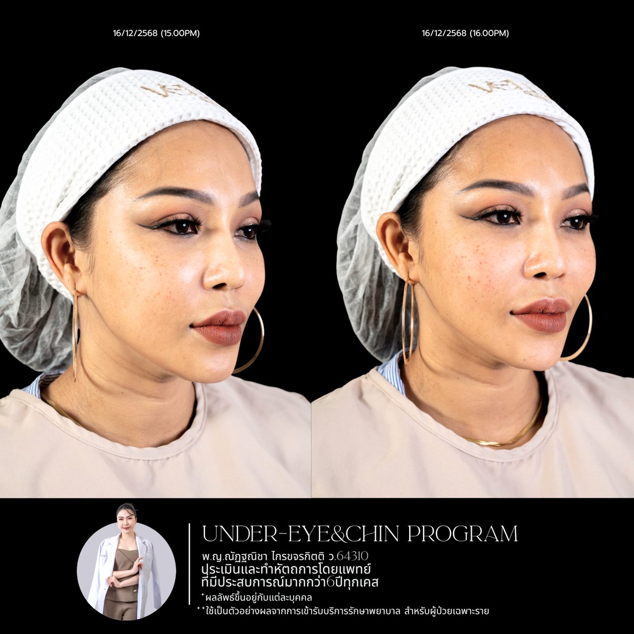 Filler ใต้ตา
