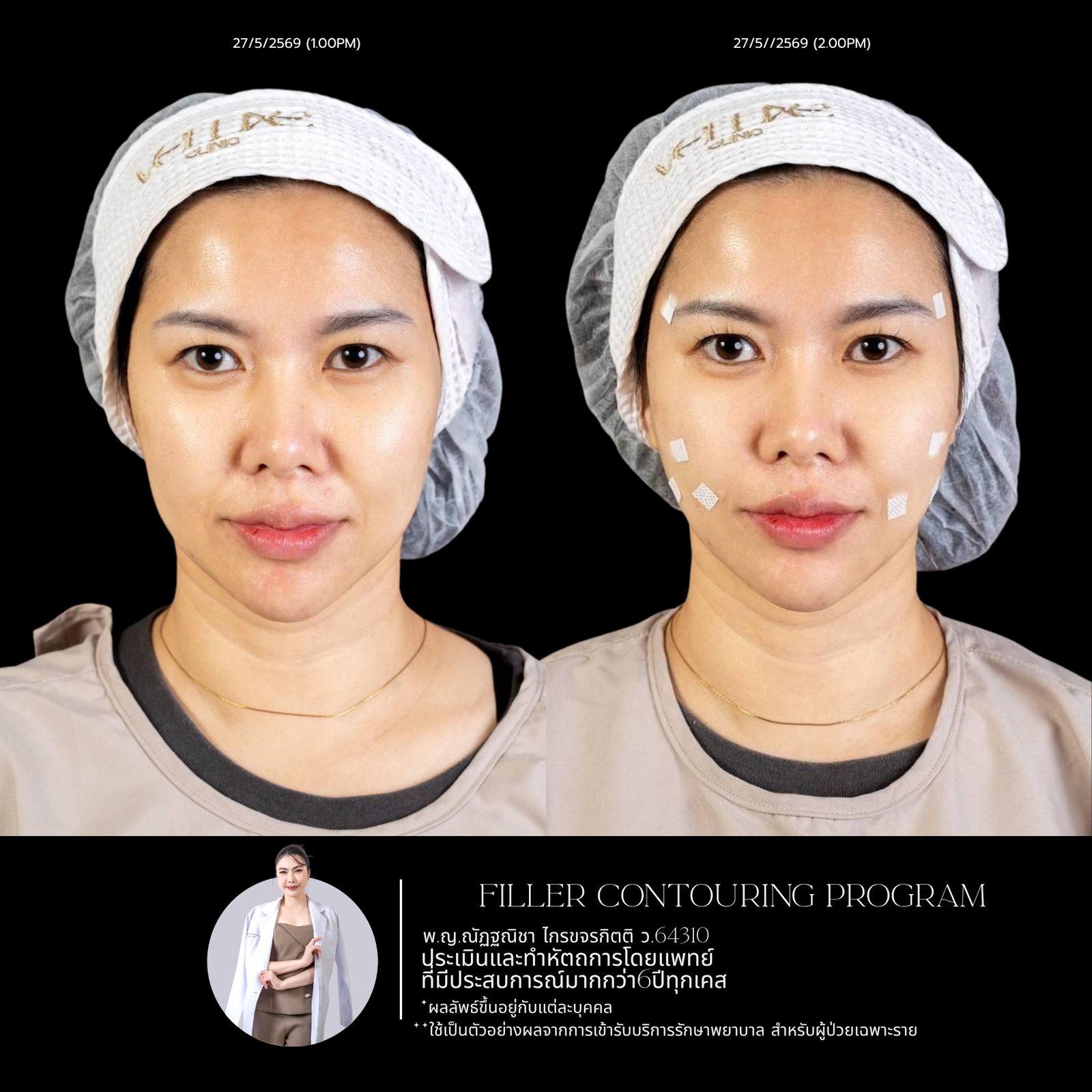Full-face filler
