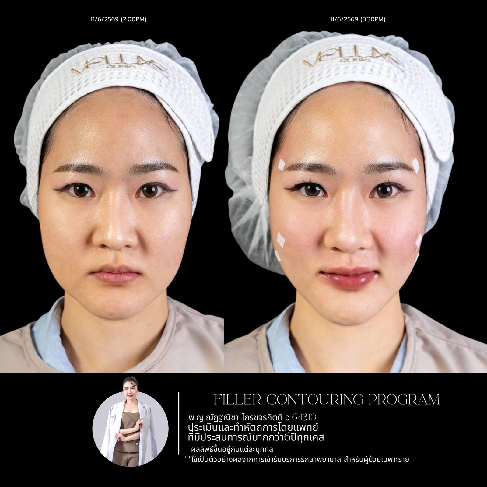Full-face filler