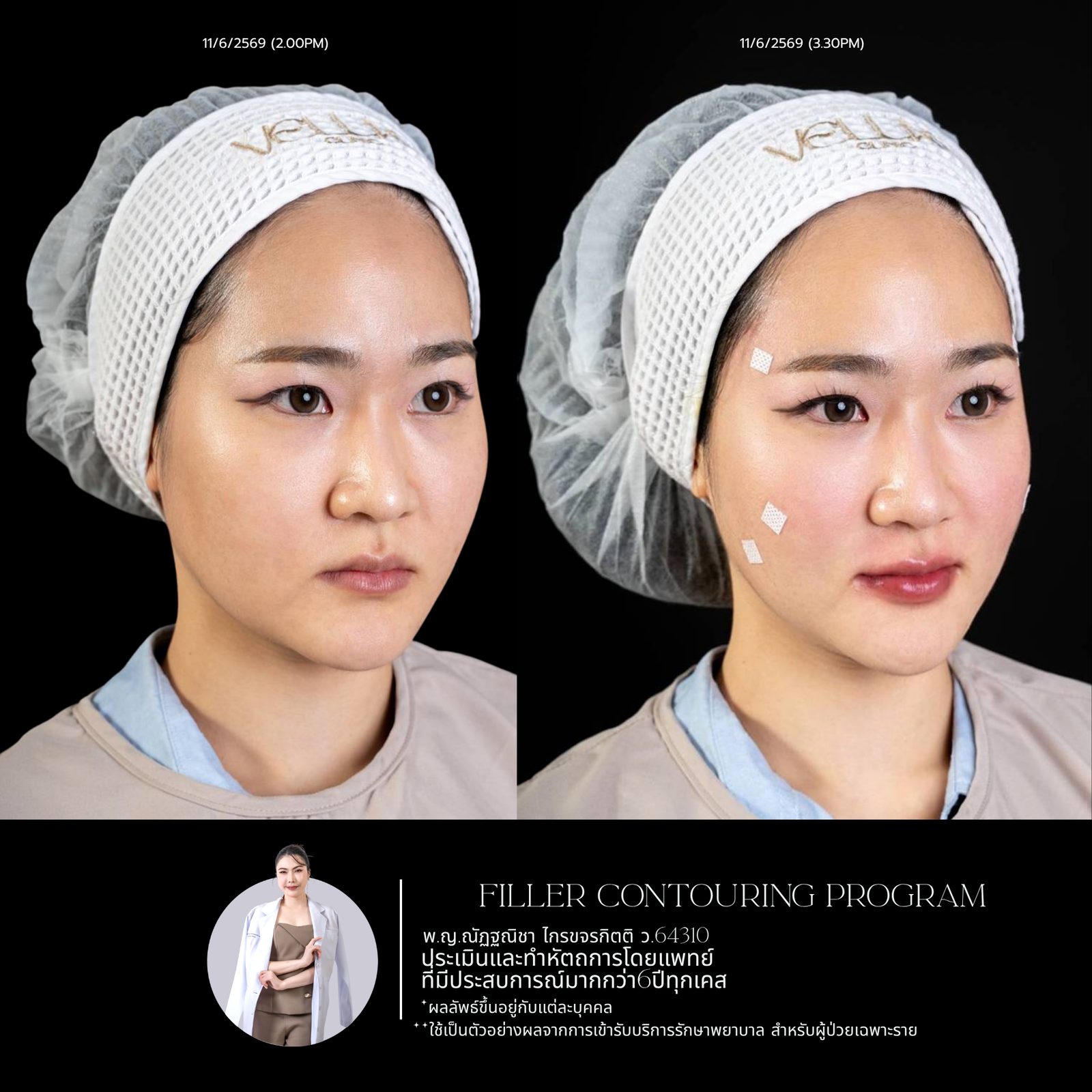 Full-face filler