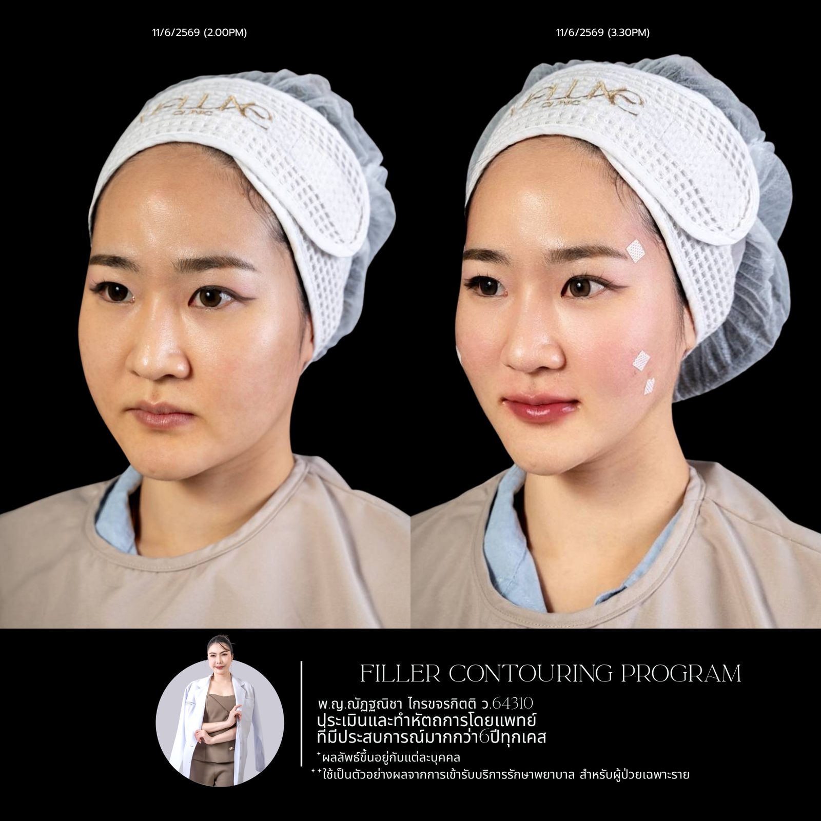 Full-face filler