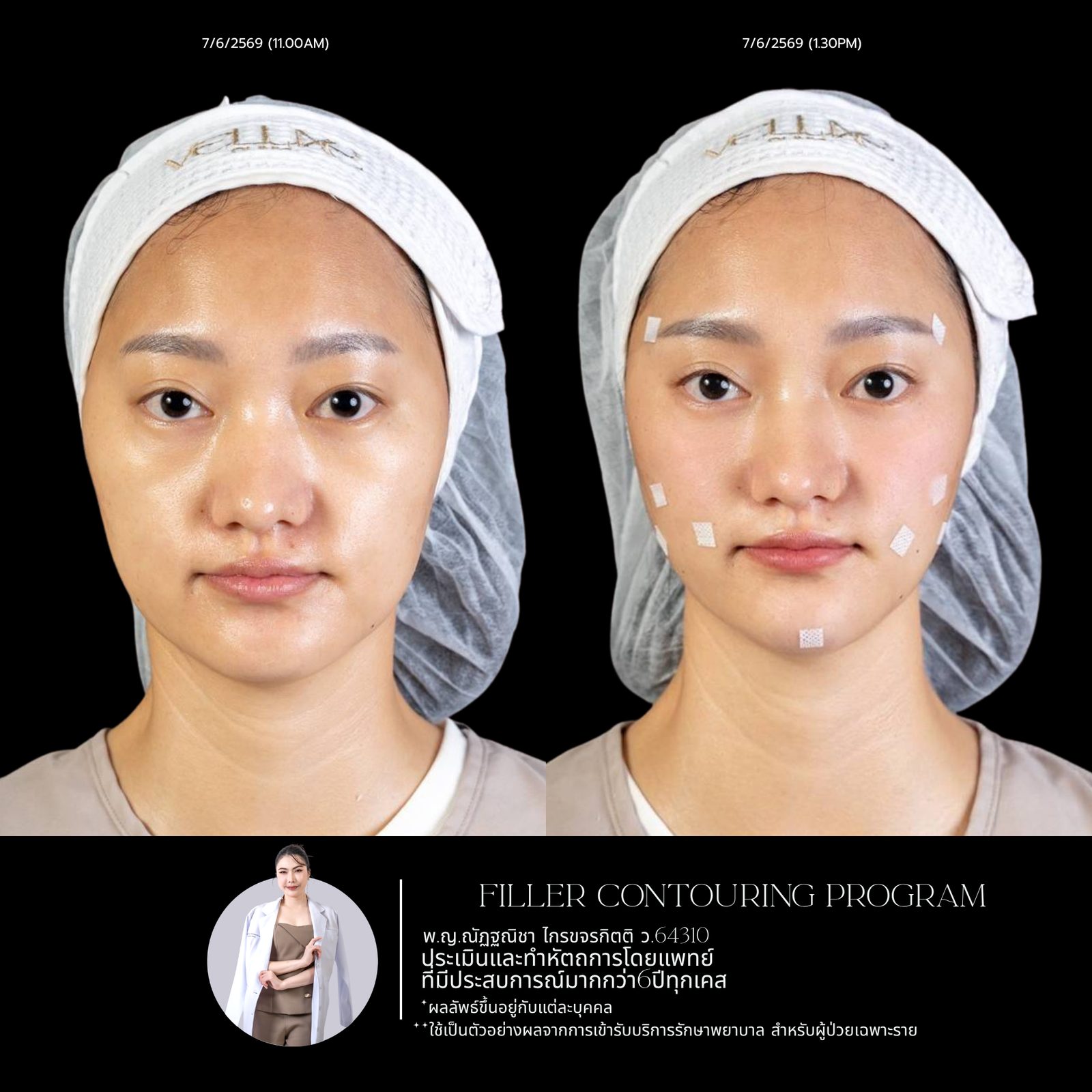 Full-face filler