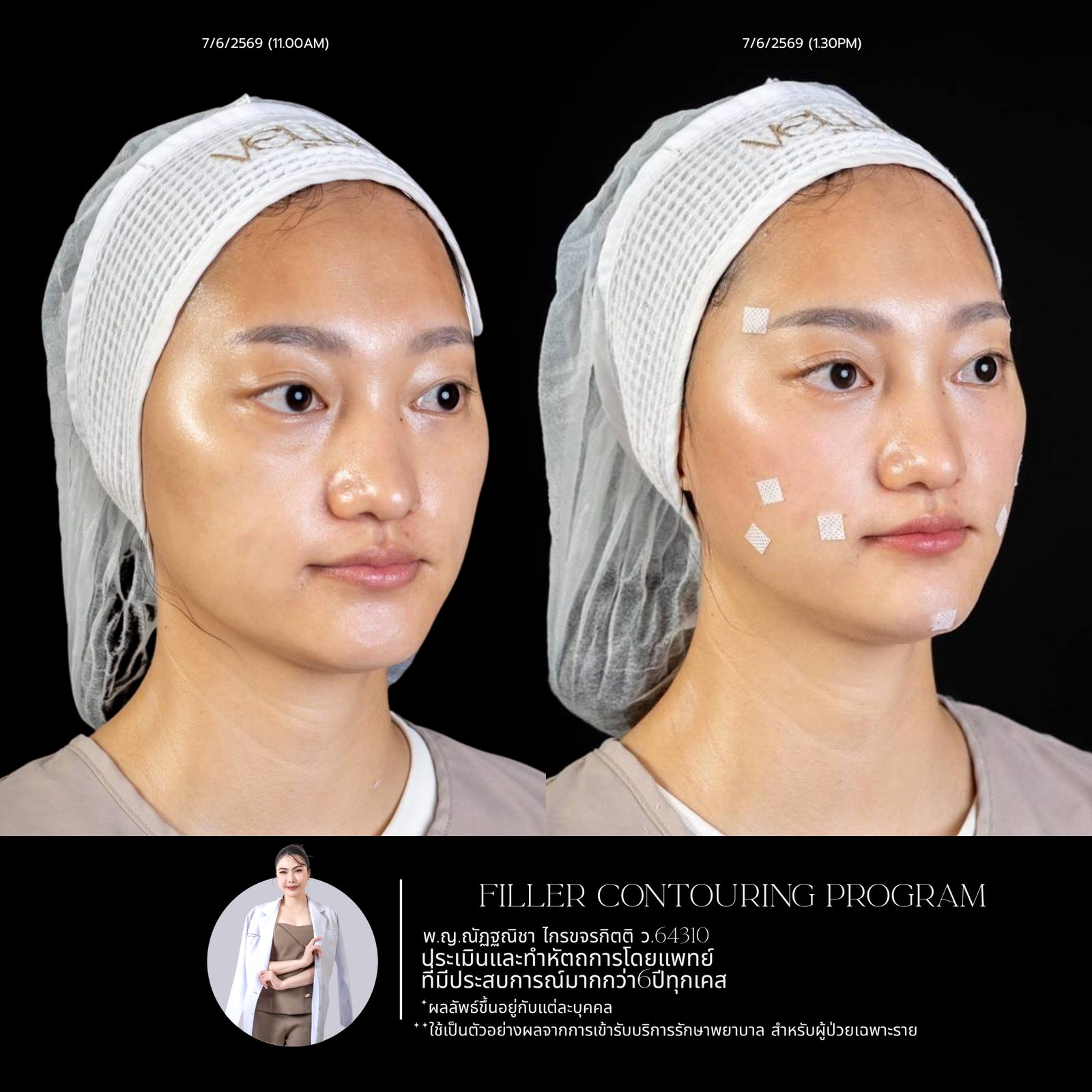 Full-face filler