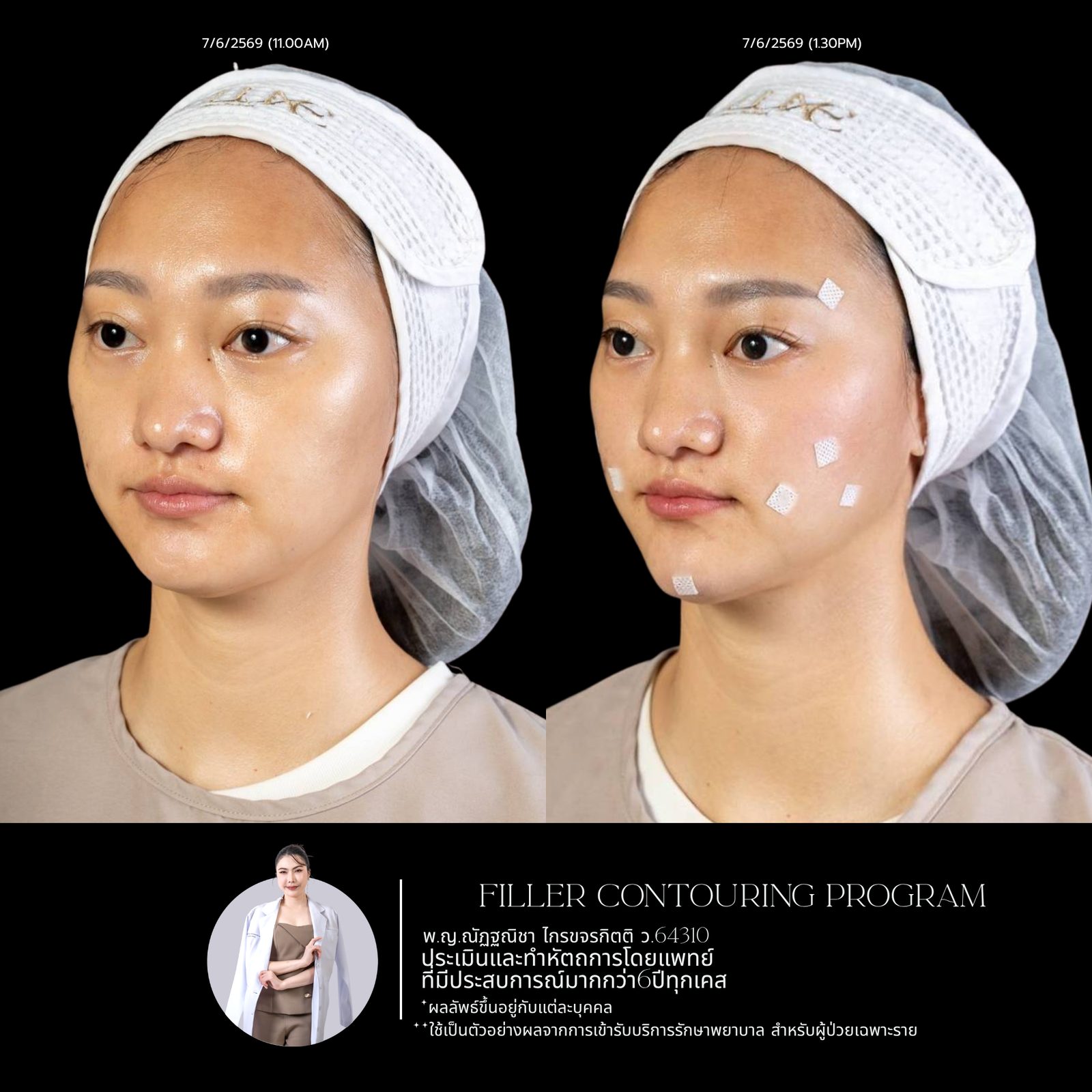 Full-face filler