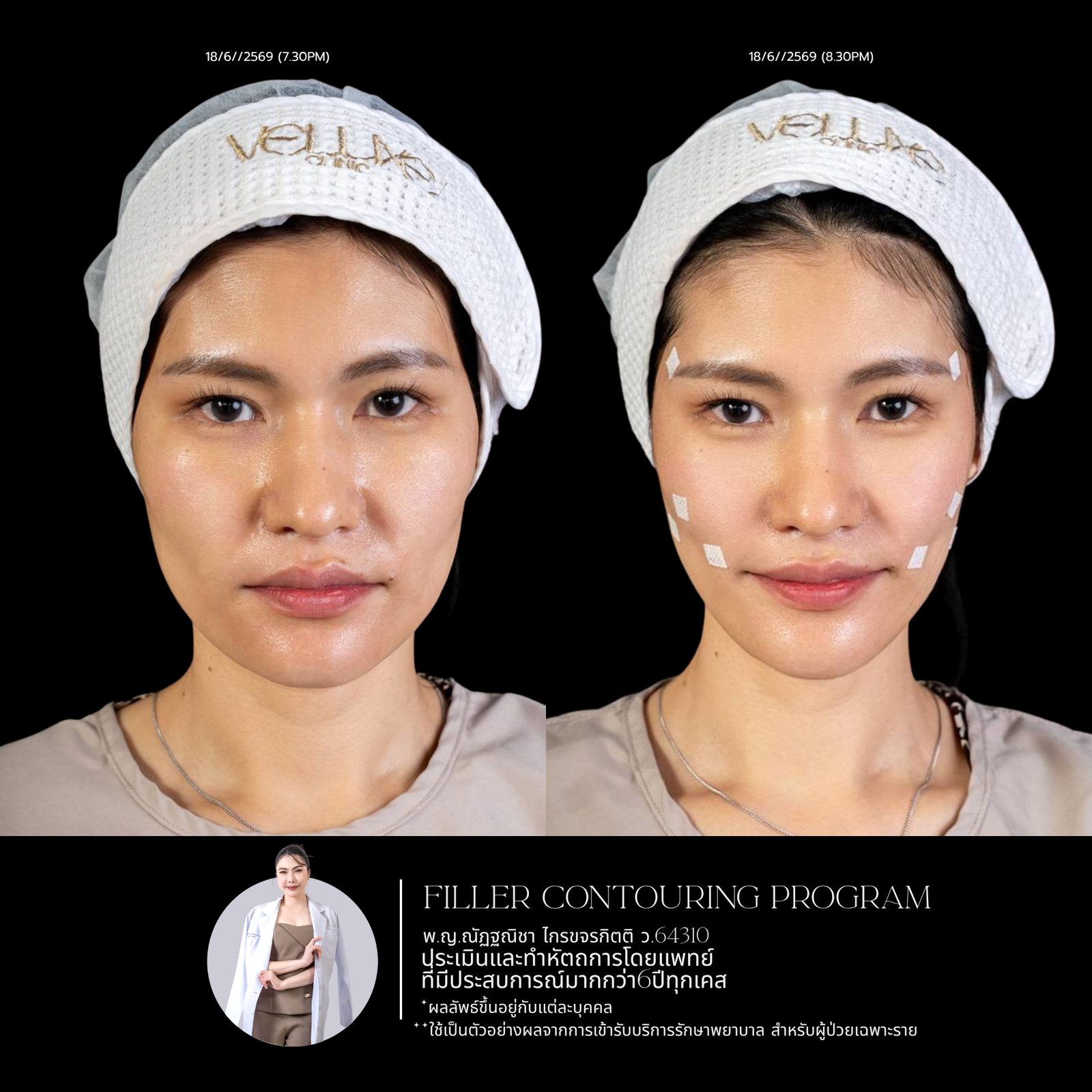 Full-face filler
