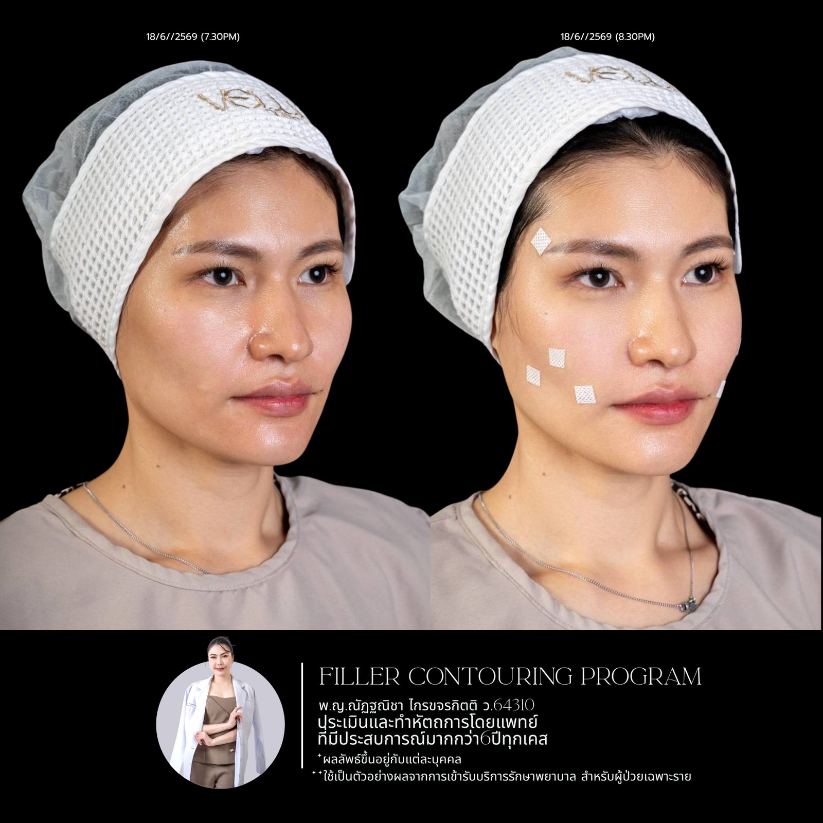 Full-face filler