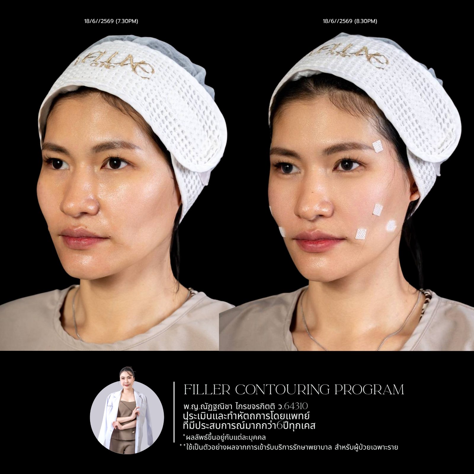 Full-face filler