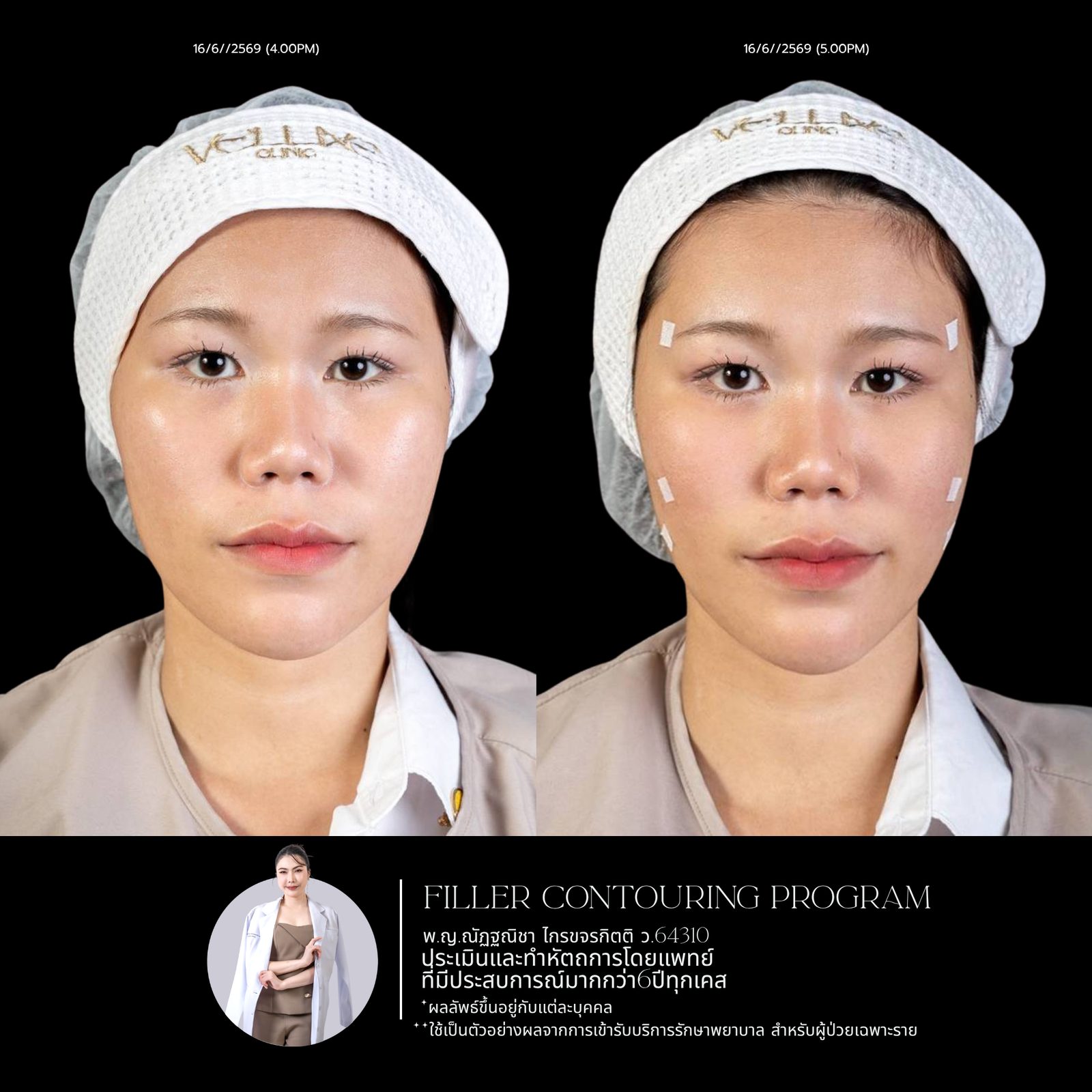 Full-face filler