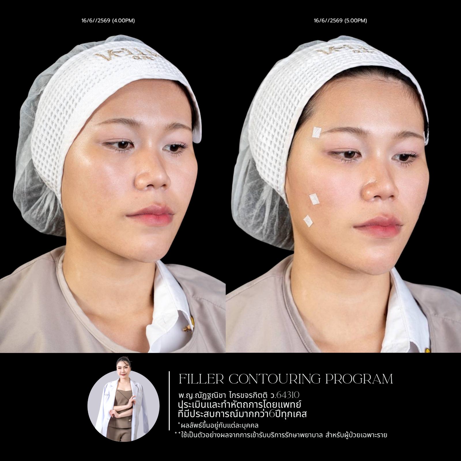 Full-face filler