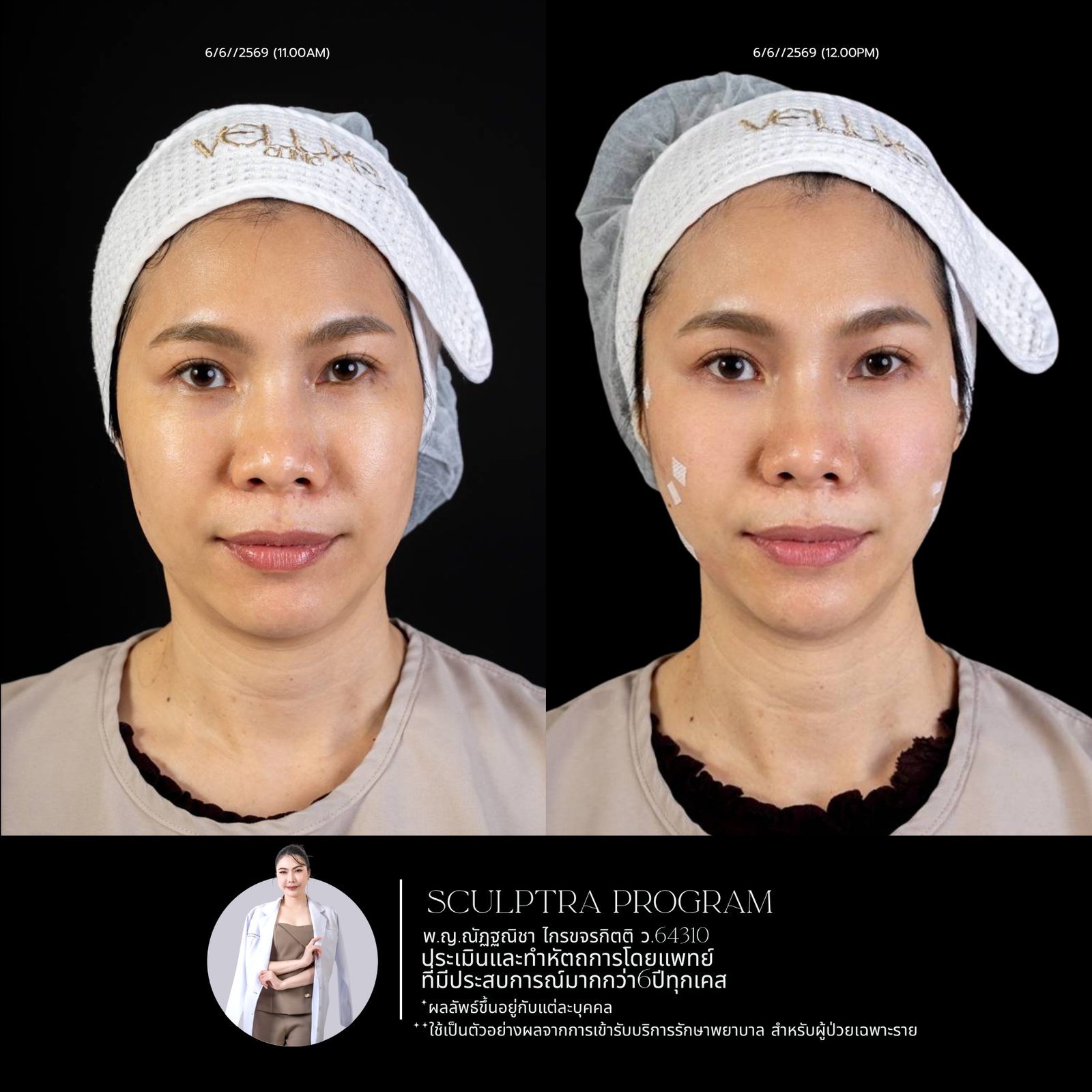 Sculptra