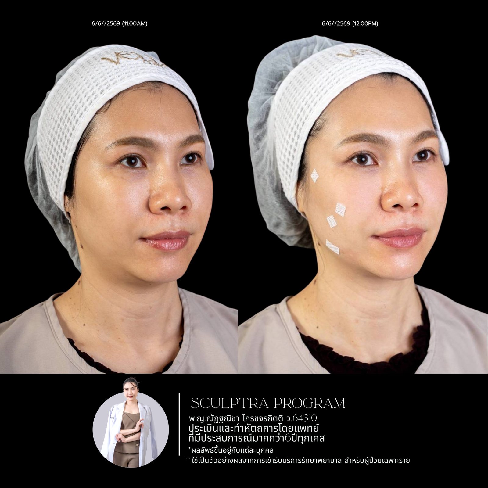 Sculptra