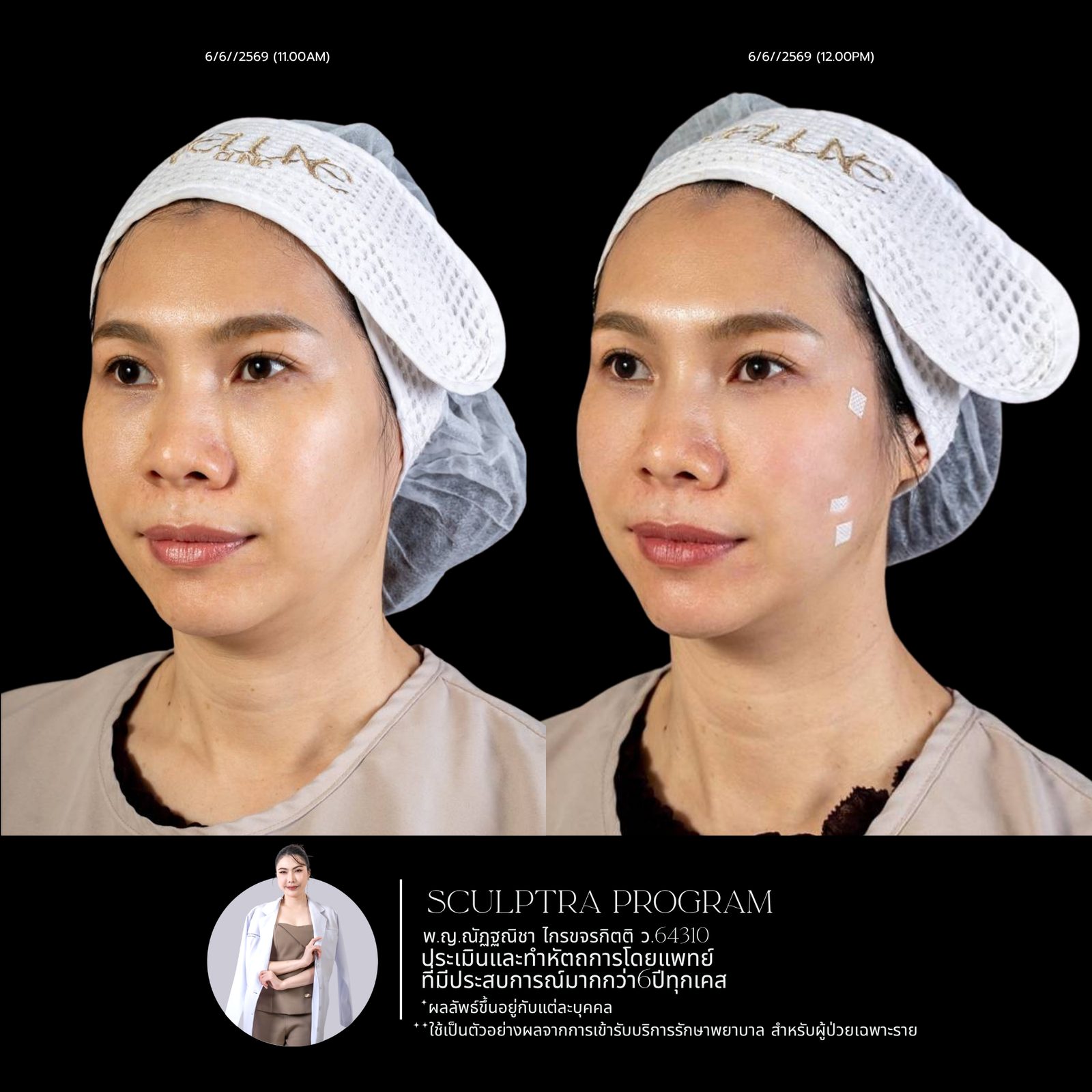 Sculptra