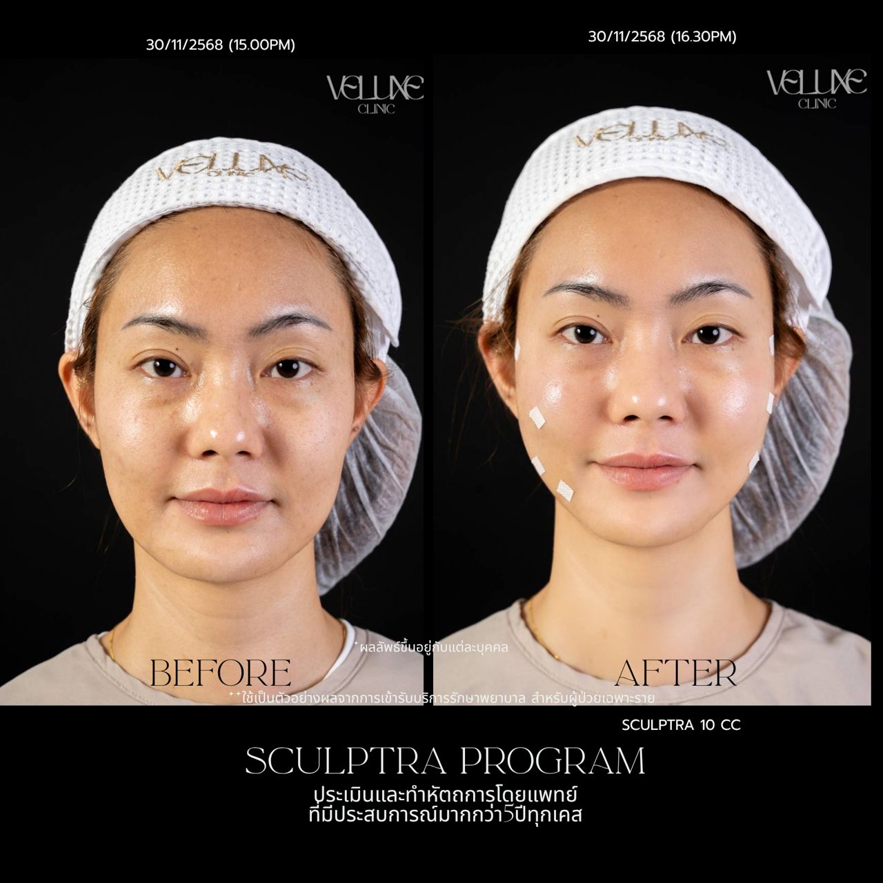 Sculptra