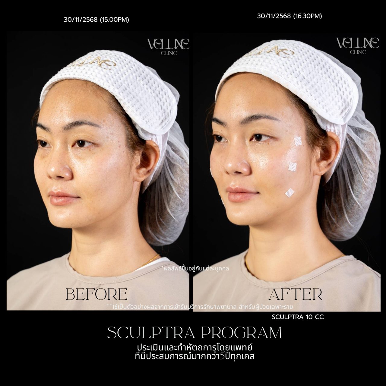 Sculptra