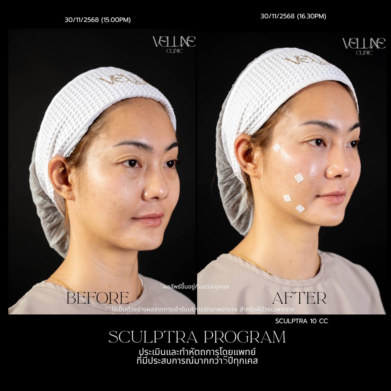 Sculptra