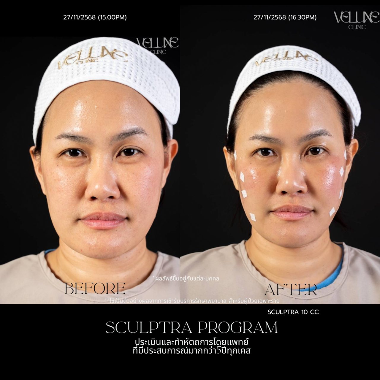 Sculptra