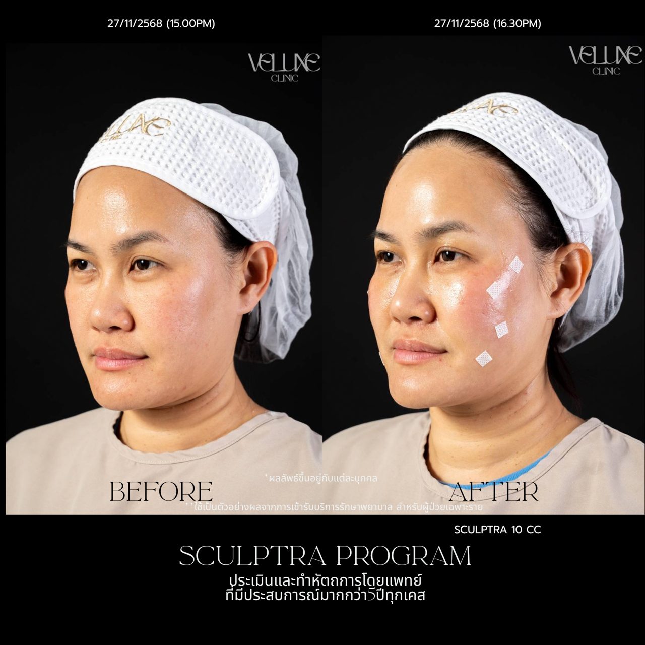 Sculptra