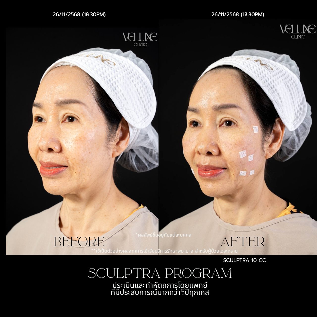 Sculptra