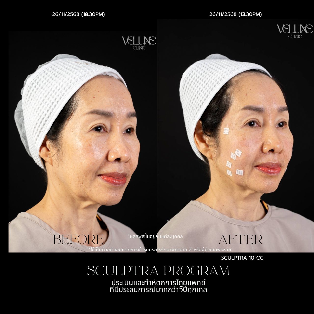Sculptra