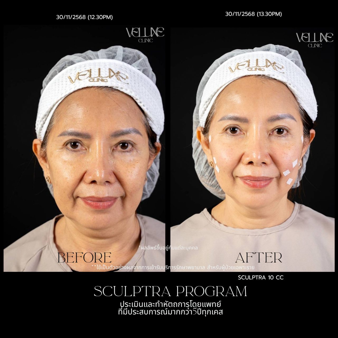 Sculptra