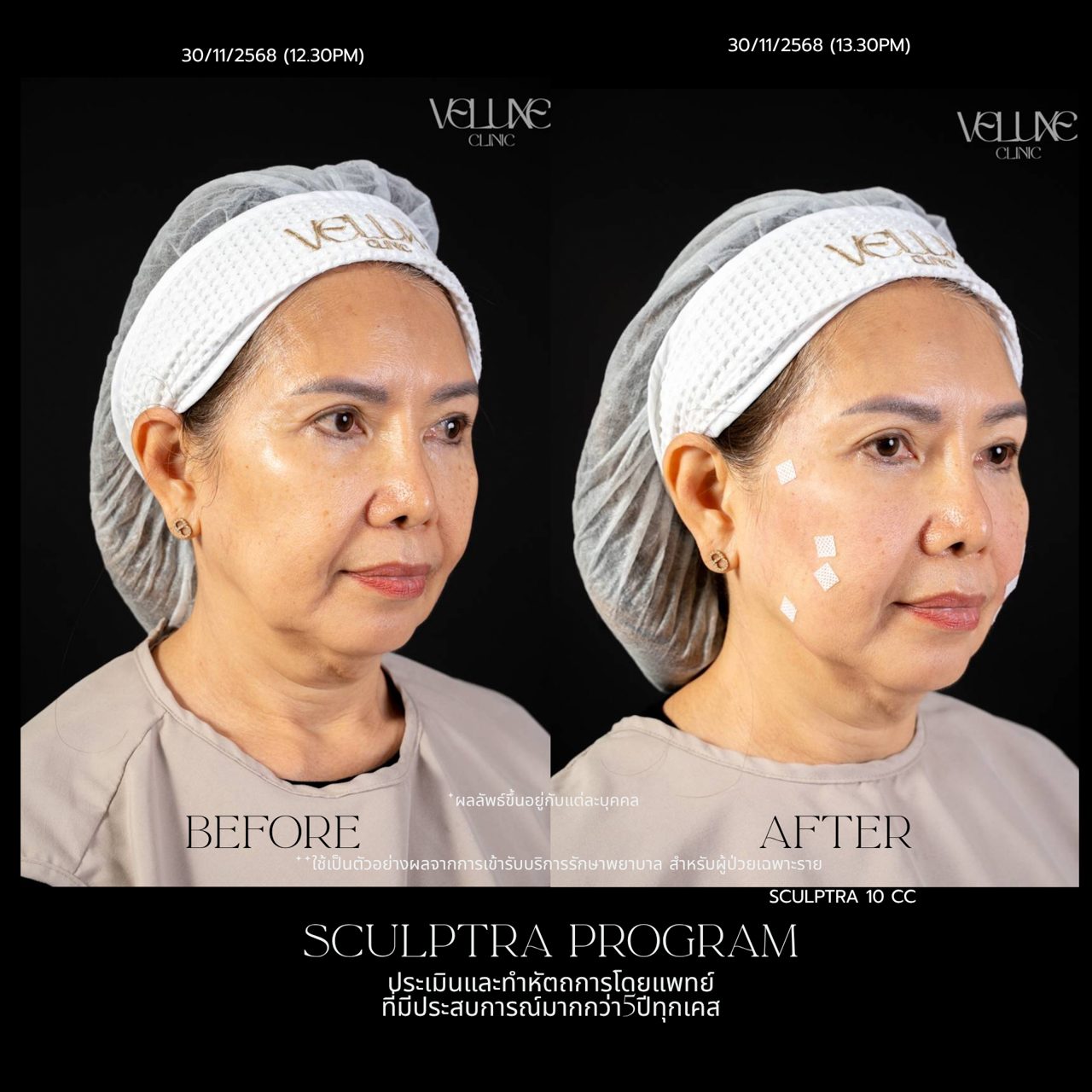 Sculptra