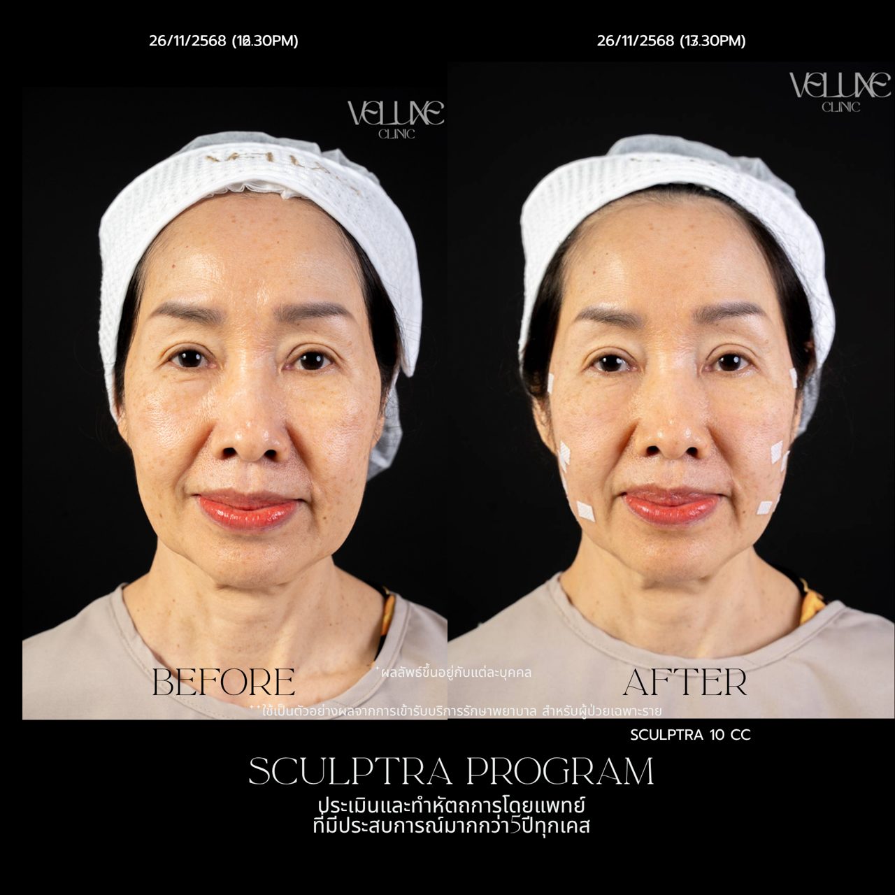 Sculptra