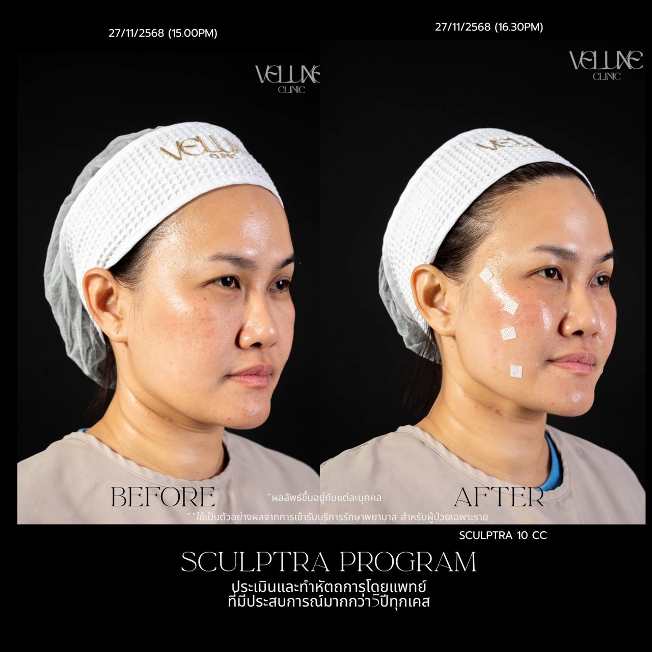 Sculptra
