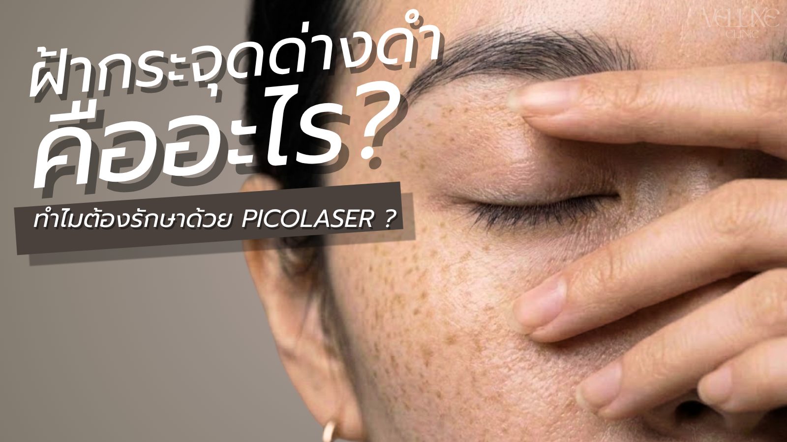 ฝ้า กระ จุดด่างดำ รักษาด้วย Pico Laser เชียงใหม่ ได้ผลจริงไห