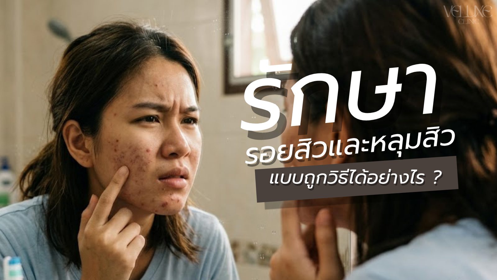 รักษารอยสิวและหลุมสิวได้อย่างไร? ครบทุกวิธีที่ได้ผลจริง