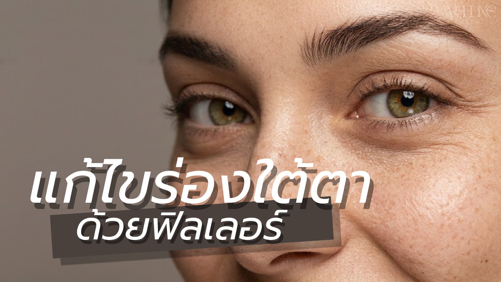 ถุงใต้ตาและร่องตา แก้ด้วยฟิลเลอร์ Tear Trough ได้จริงไหม?